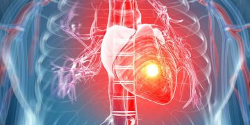Definition and Risk Factor for Acute Myocardial Infarction