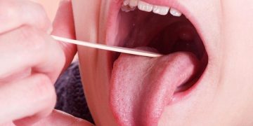 Tongue Cancer: Causes, Symptoms and How to Prevent it