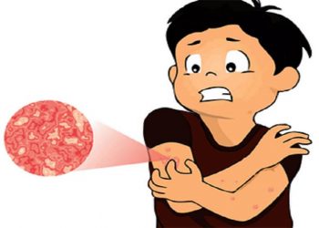 Herpes Zoster: Cause, Symptoms, Prevention, and Treatment