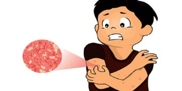 Herpes Zoster: Cause, Symptoms, Prevention, and Treatment
