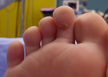 How to Overcome Clavus (Fisheye) Disease