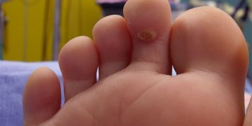 How to Overcome Clavus (Fisheye) Disease